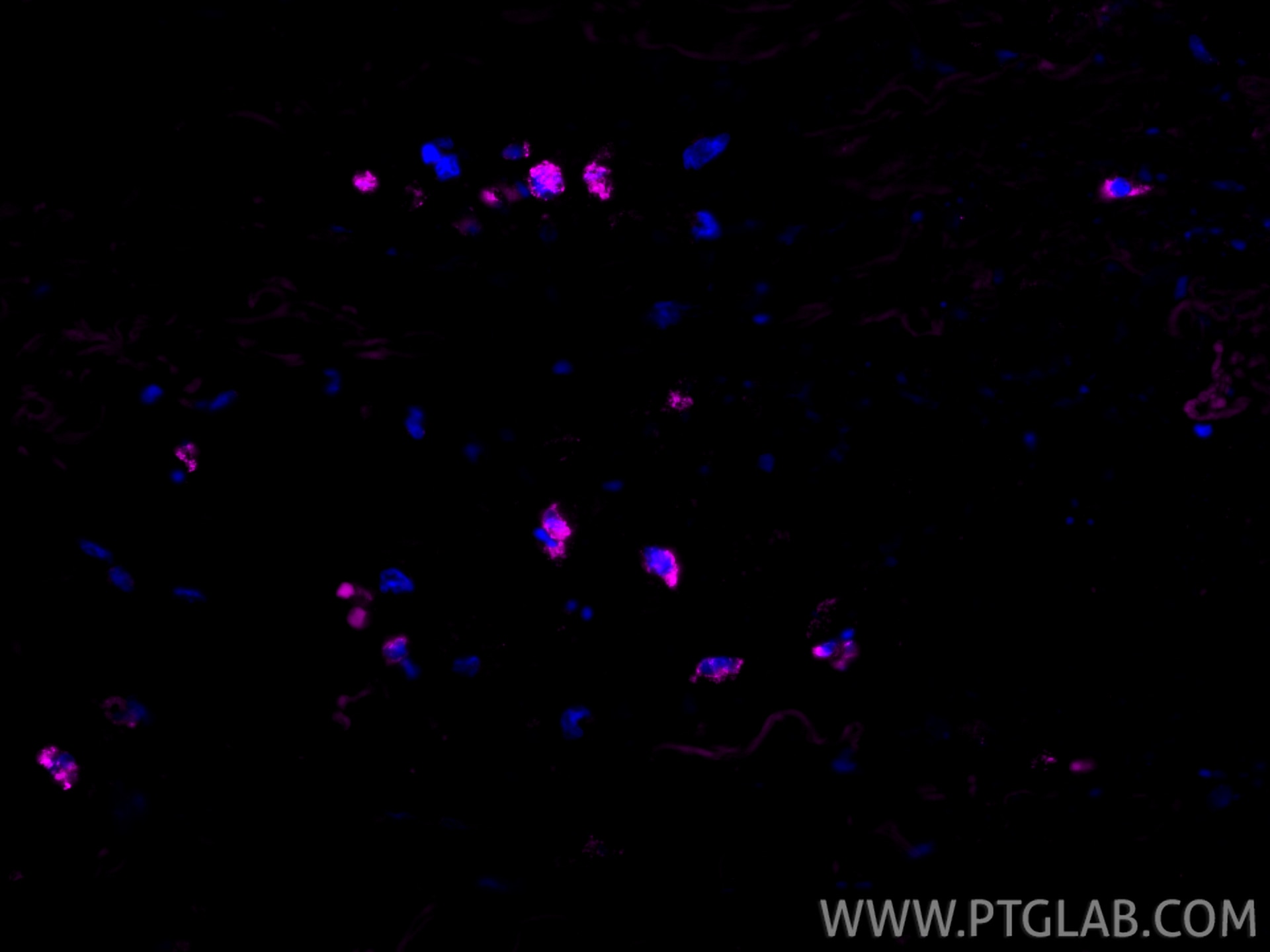 IF Staining of human lung cancer using APC-13588 Immunofluorescence (IF) / fluorescent staining of human lung cancer tissue using APC-conjugated Granzyme B Polyclonal antibody (APC-13588)