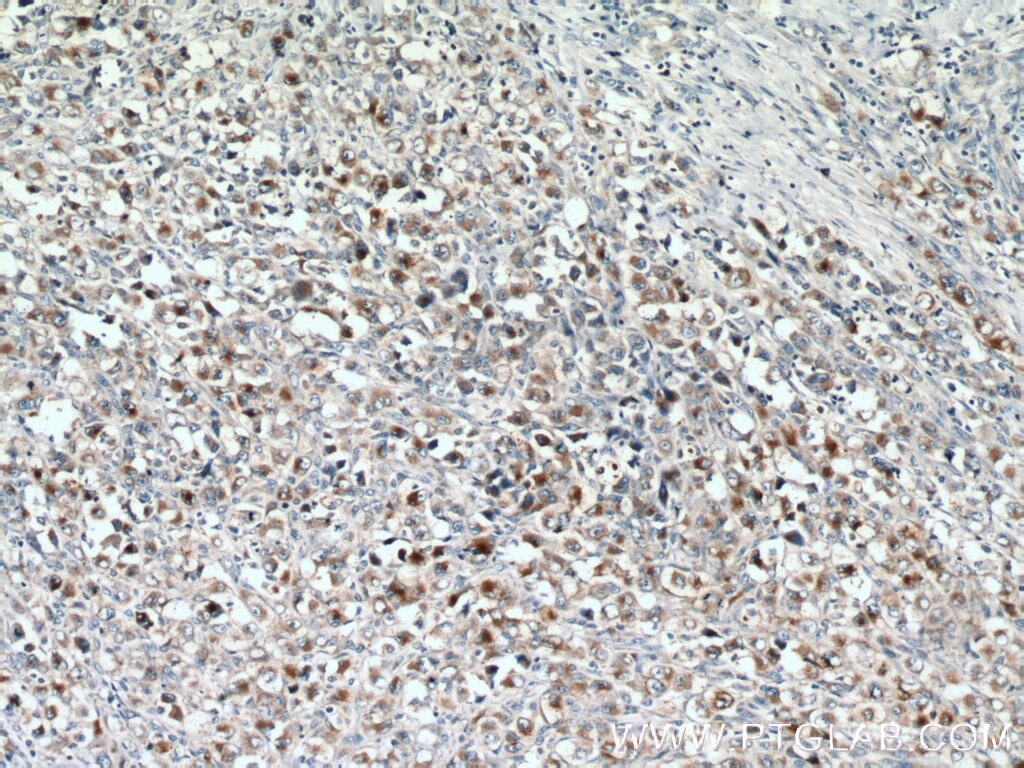 Immunohistochemistry (IHC) staining of human lymphoma tissue using Granzyme B Polyclonal antibody (13588-1-AP)