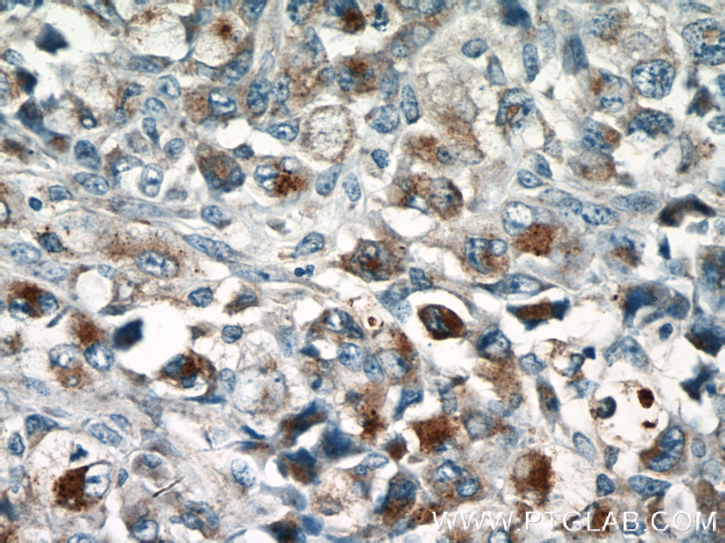 Immunohistochemistry (IHC) staining of human lymphoma tissue using Granzyme B Polyclonal antibody (13588-1-AP)