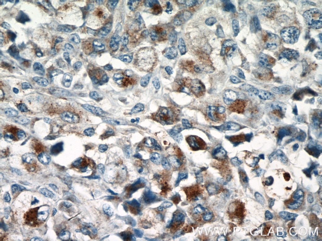 IHC staining of human lymphoma using 13588-1-AP