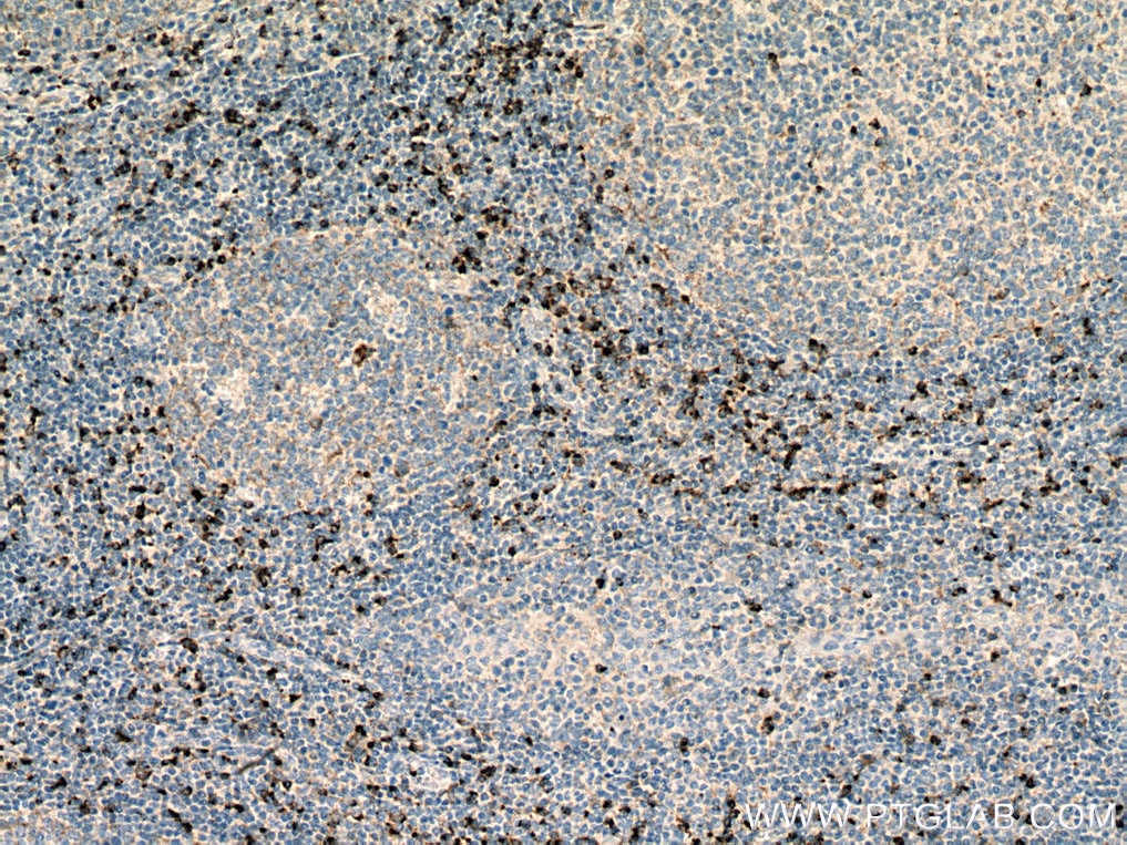 Immunohistochemistry (IHC) staining of human tonsillitis tissue using Granzyme K Polyclonal antibody (27894-1-AP)