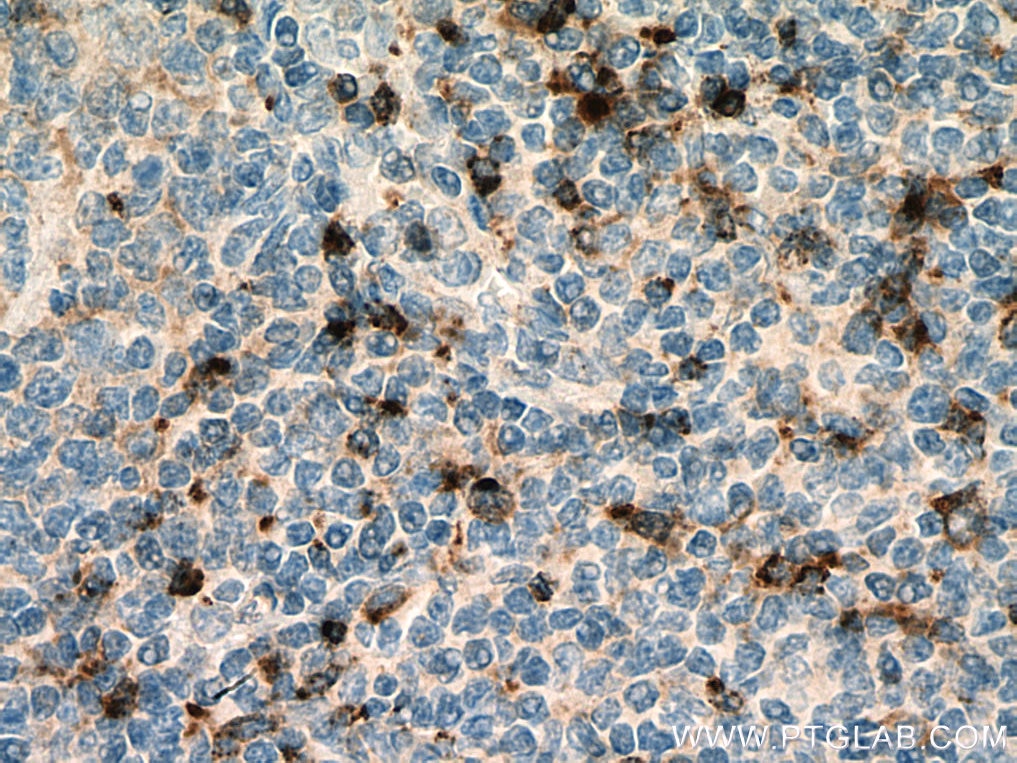 Immunohistochemistry (IHC) staining of human tonsillitis tissue using Granzyme K Polyclonal antibody (27894-1-AP)