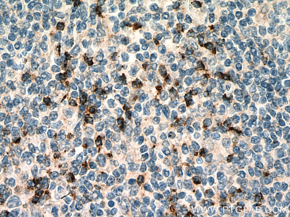 Immunohistochemistry (IHC) staining of human tonsillitis tissue using Granzyme K Monoclonal antibody (67272-1-Ig)