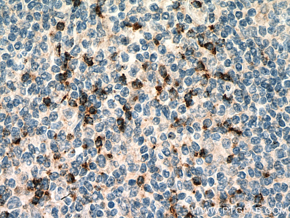 IHC staining of human tonsillitis using 67272-1-Ig