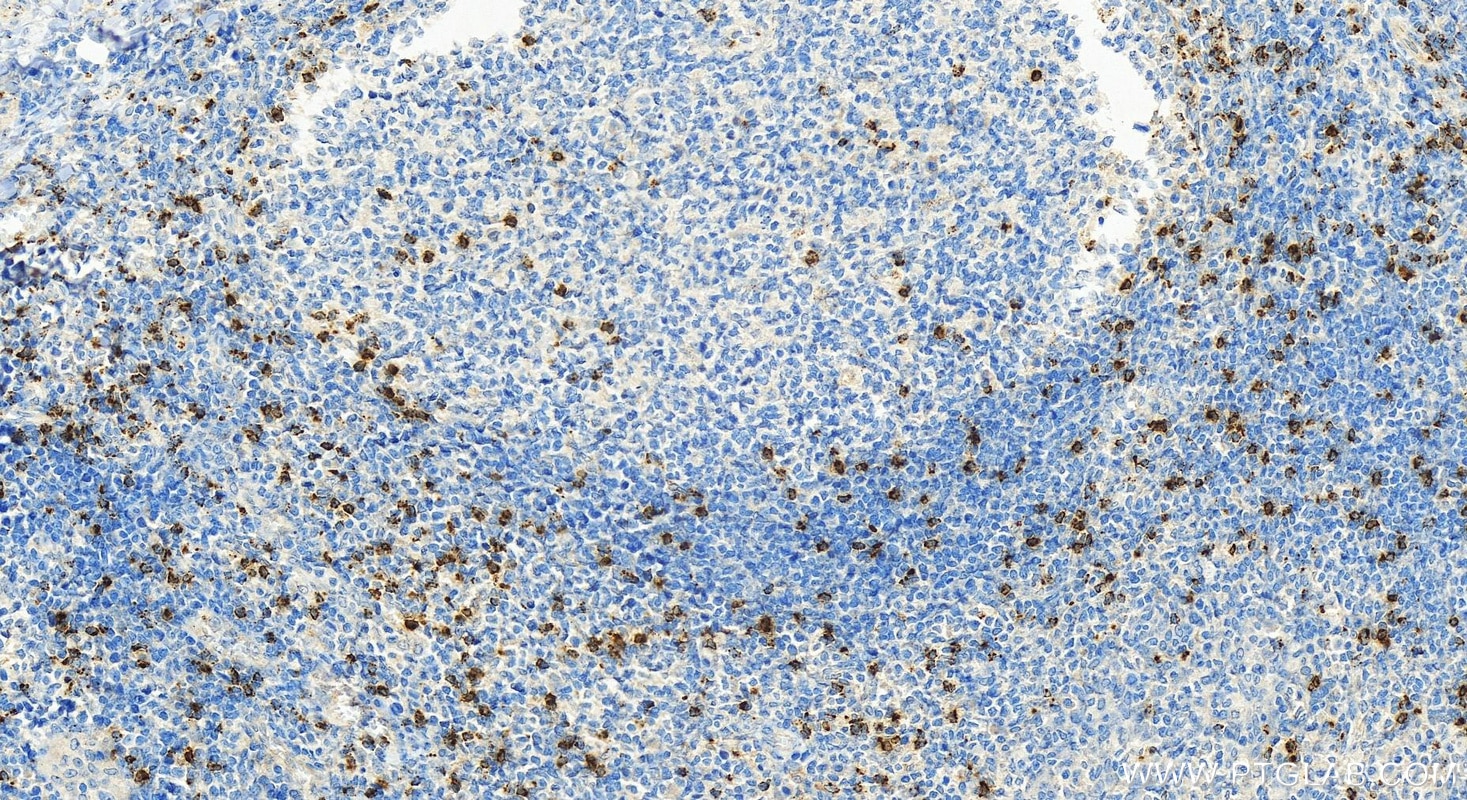 Immunohistochemistry (IHC) staining of human tonsillitis tissue using Granzyme K Monoclonal antibody (67272-1-Ig)