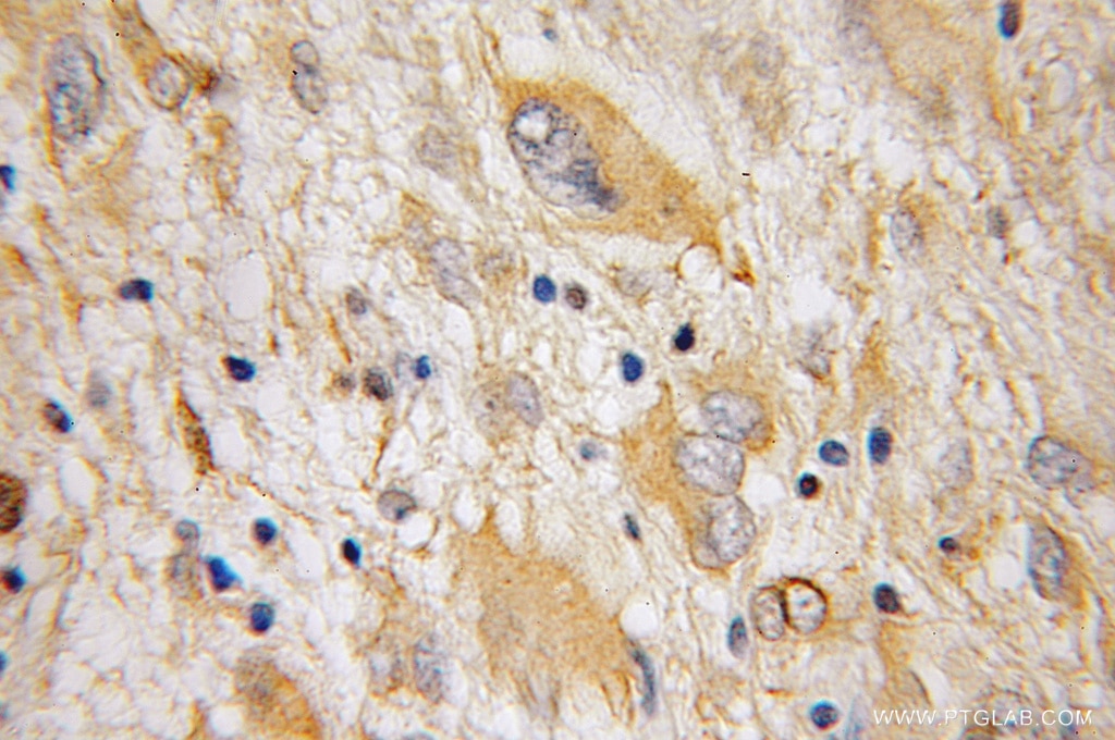 IHC staining of human gliomas using 11991-1-AP