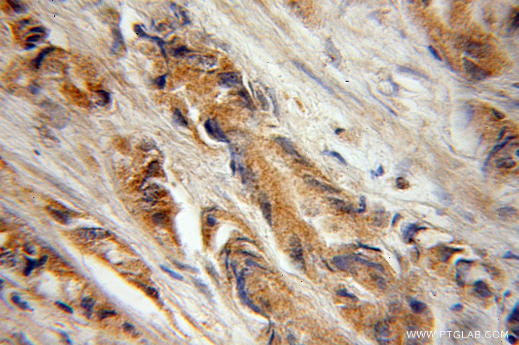 Immunohistochemistry (IHC) staining of human prostate cancer tissue using Galc Polyclonal antibody (51049-2-AP)