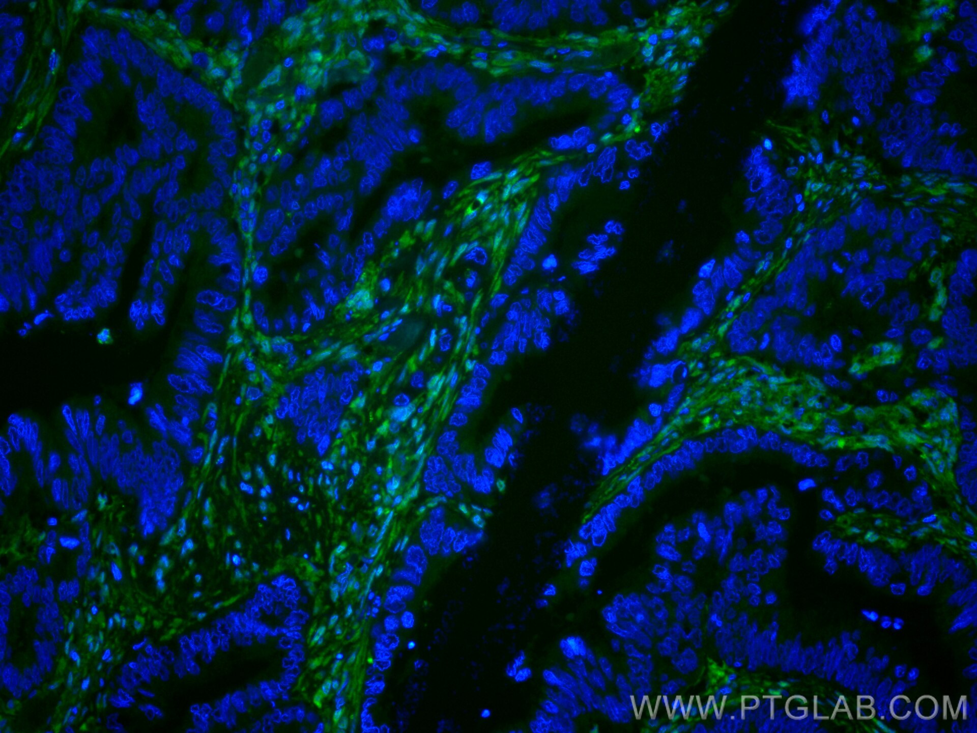 Immunofluorescence (IF) / fluorescent staining of human colon cancer tissue using CoraLite® Plus 488-conjugated Galectin-1 Monoclona (CL488-60223)