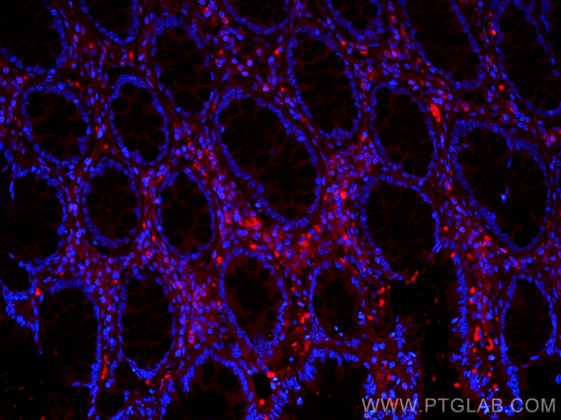 Immunofluorescence (IF) / fluorescent staining of human colon cancer tissue using CoraLite®594-conjugated Galectin-1 Monoclonal anti (CL594-60223)