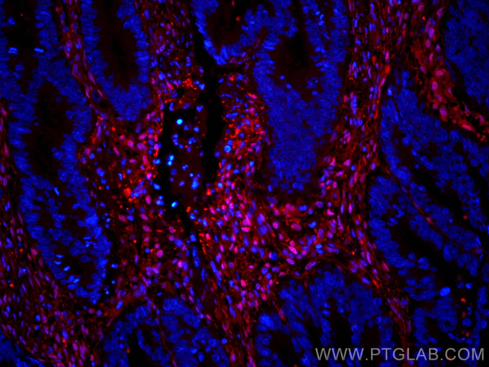 IF Staining of human colon cancer using CL594-60223