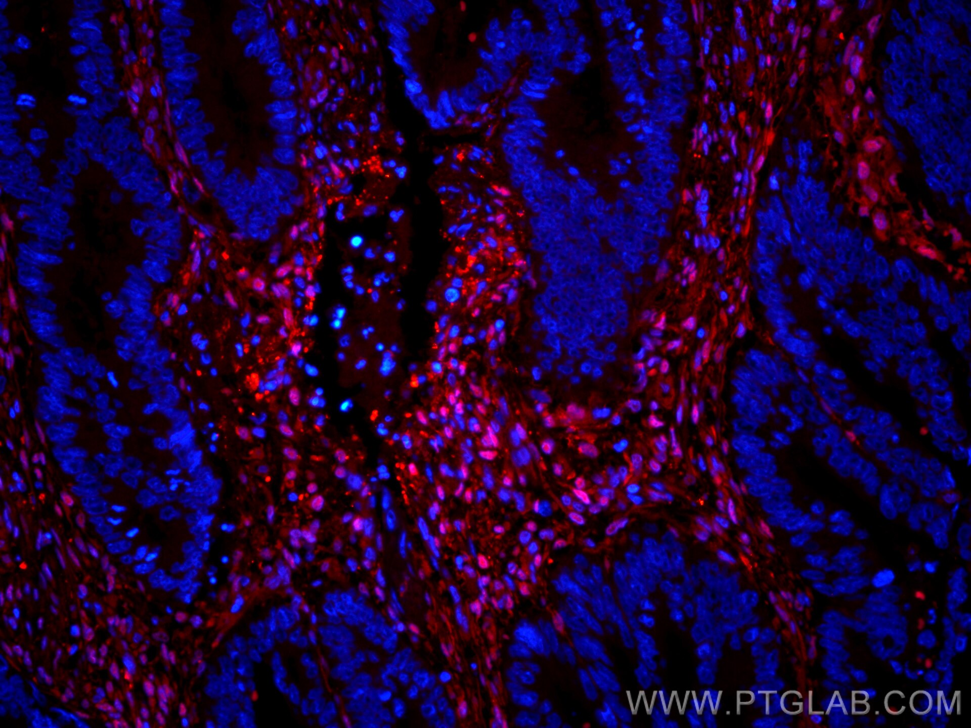 Immunofluorescence (IF) / fluorescent staining of human colon cancer tissue using CoraLite®594-conjugated Galectin-1 Monoclonal anti (CL594-60223)