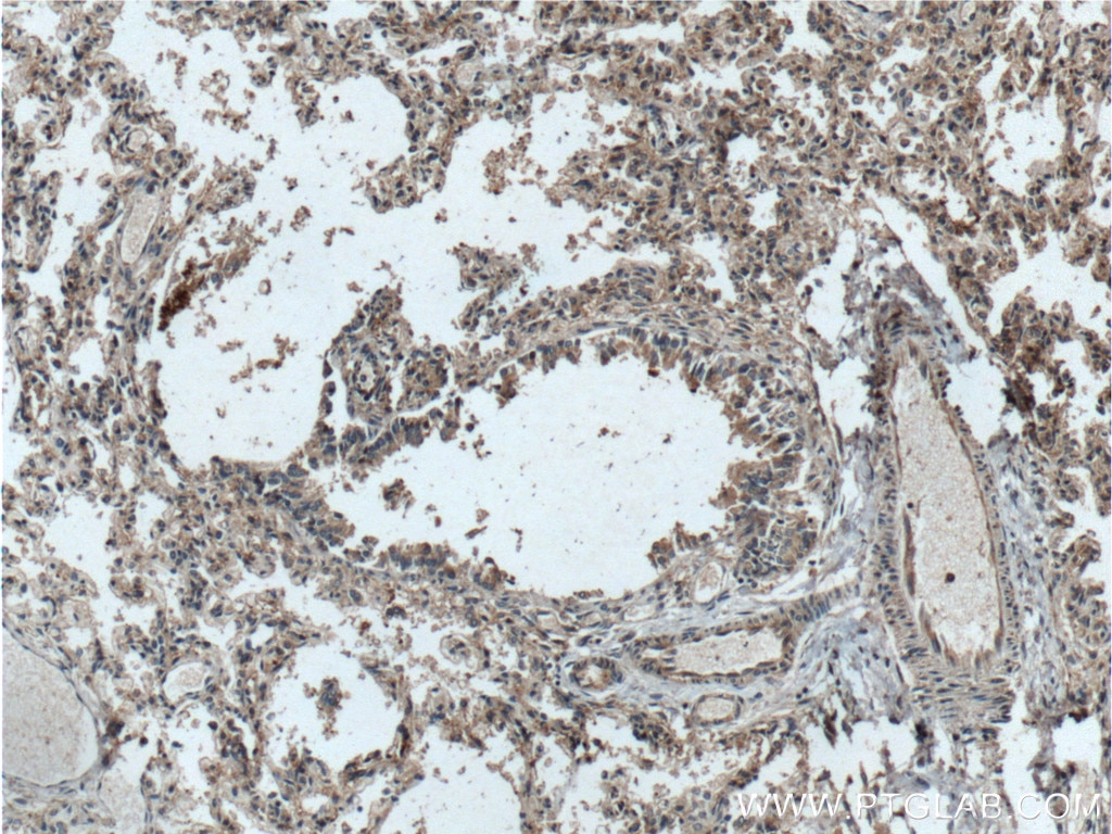 Immunohistochemistry (IHC) staining of human lung tissue using Galectin 10 Polyclonal antibody (25225-1-AP)