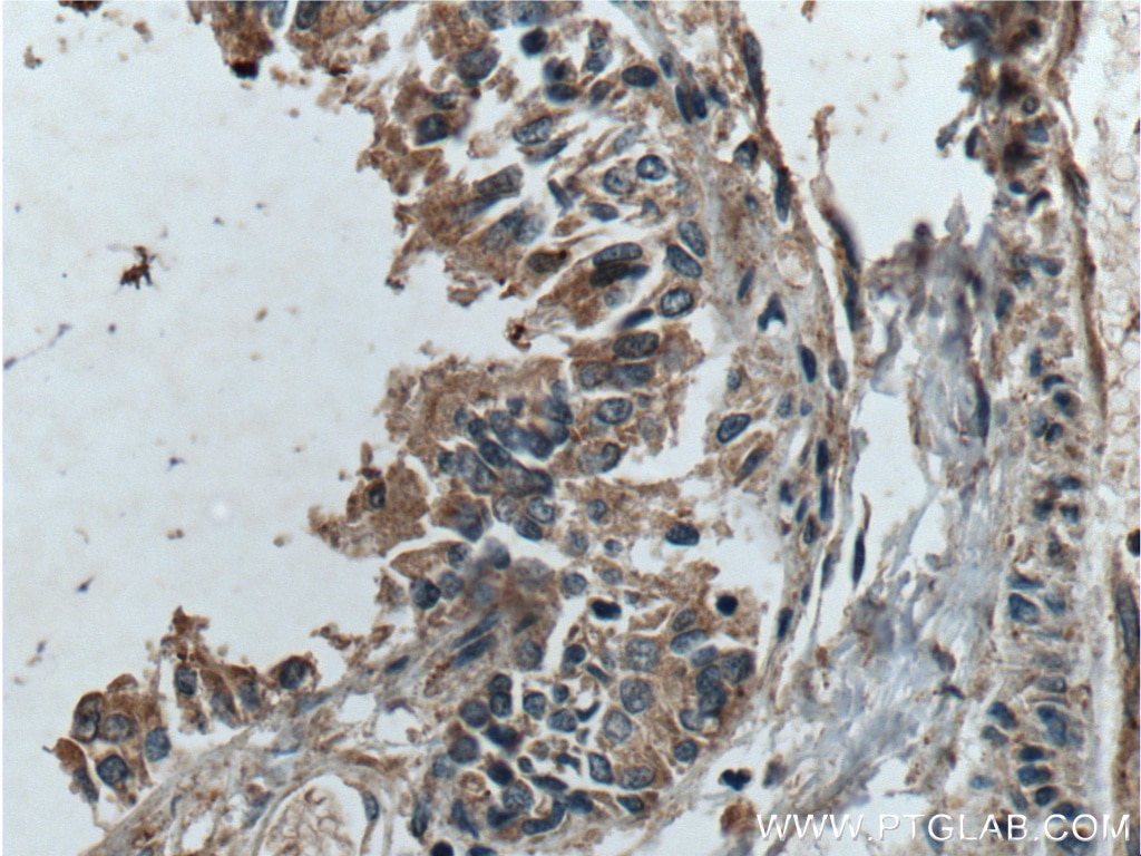 Immunohistochemistry (IHC) staining of human lung tissue using Galectin 10 Polyclonal antibody (25225-1-AP)