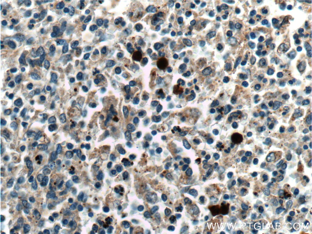 Immunohistochemistry (IHC) staining of human spleen tissue using Galectin 10 Polyclonal antibody (25225-1-AP)