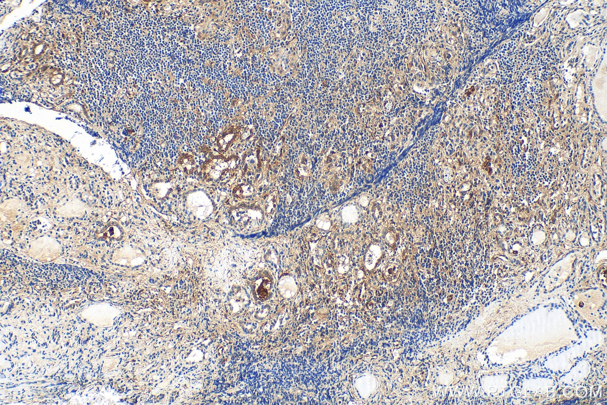 Immunohistochemistry (IHC) staining of human thyroid cancer tissue using Galectin 3 Polyclonal antibody (30450-1-AP)