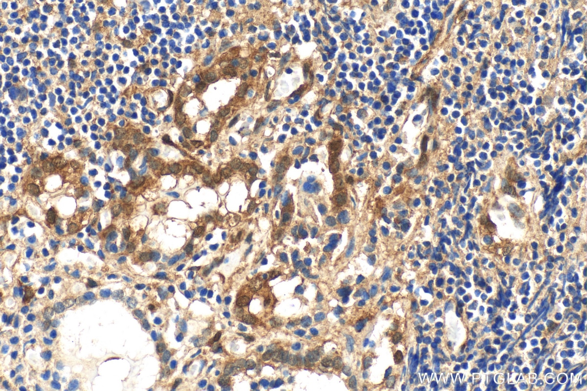Immunohistochemistry (IHC) staining of human thyroid cancer tissue using Galectin 3 Polyclonal antibody (30450-1-AP)