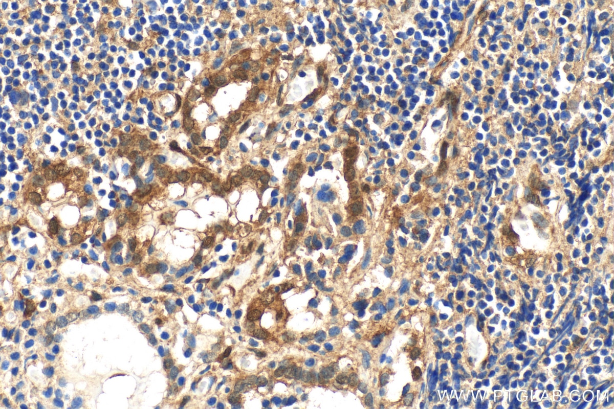 IHC staining of human thyroid cancer using 30450-1-AP