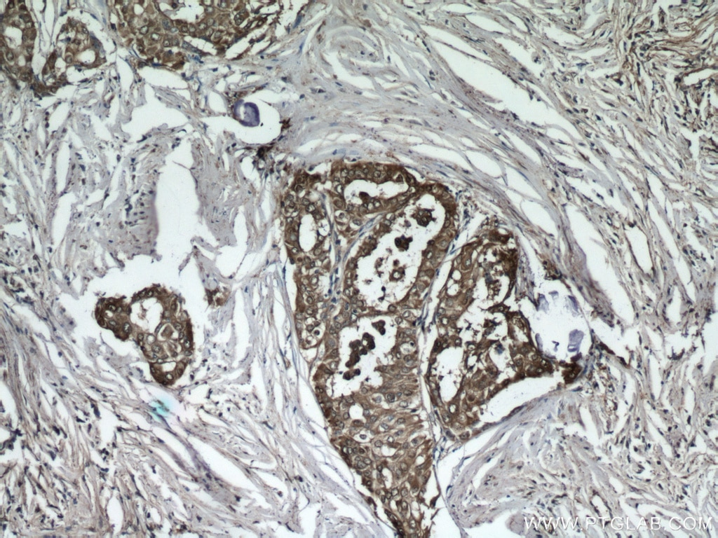 Immunohistochemistry (IHC) staining of human thyroid cancer tissue using Galectin-3 Monoclonal antibody (60207-2-Ig)