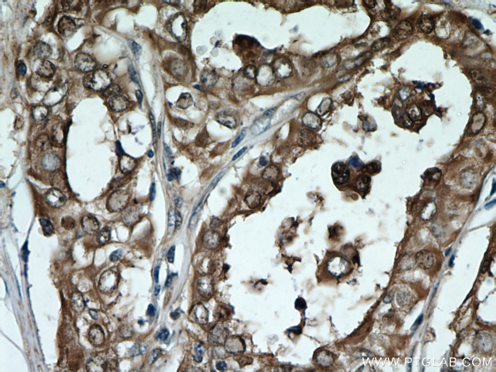 Immunohistochemistry (IHC) staining of human thyroid cancer tissue using Galectin-3 Monoclonal antibody (60207-2-Ig)