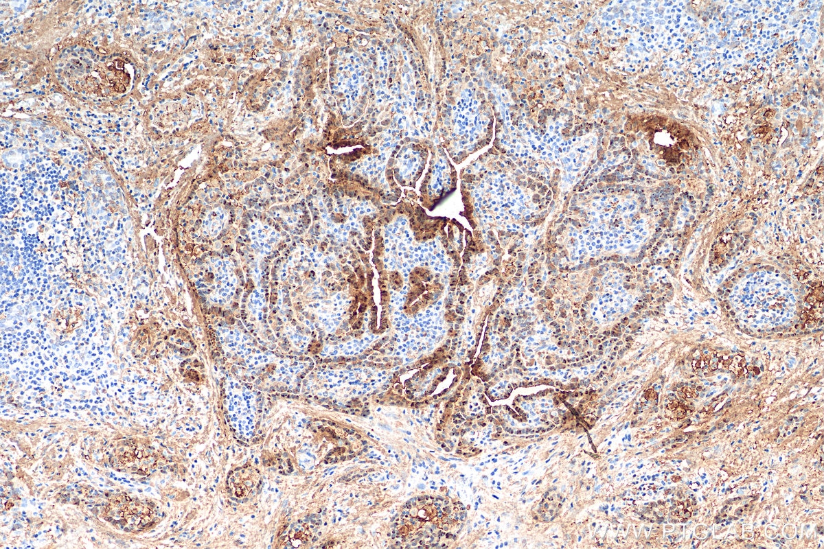 Immunohistochemistry (IHC) staining of human thyroid cancer tissue using Galectin 3 Recombinant antibody (82024-1-RR)