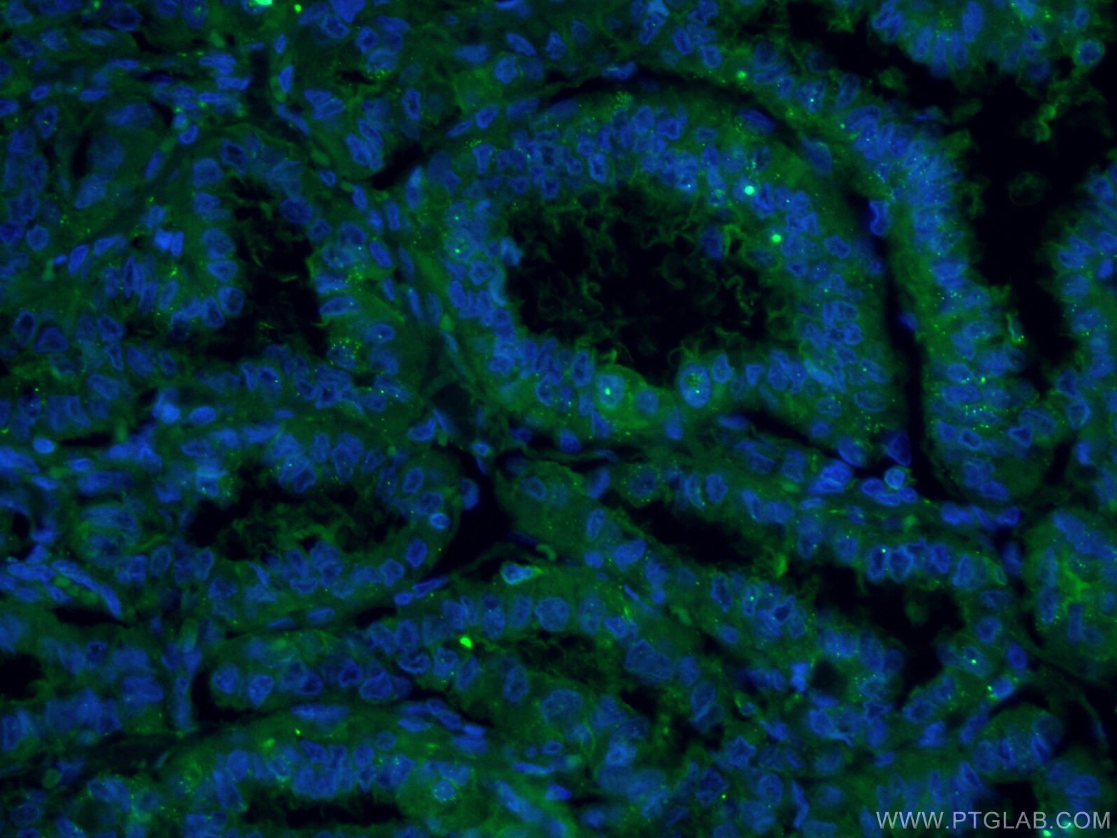 Immunofluorescence (IF) / fluorescent staining of human thyroid cancer tissue using CoraLite® Plus 488-conjugated Galectin-3 Monoclona (CL488-60207)