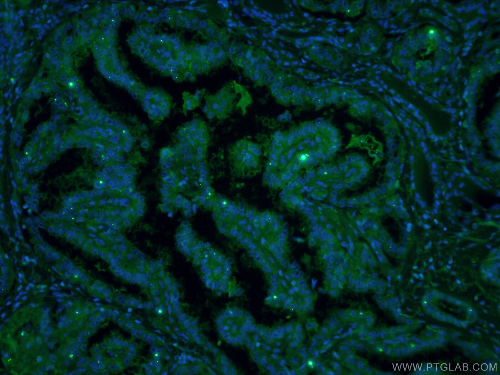 Immunofluorescence (IF) / fluorescent staining of human thyroid cancer tissue using CoraLite® Plus 488-conjugated Galectin-3 Monoclona (CL488-60207)