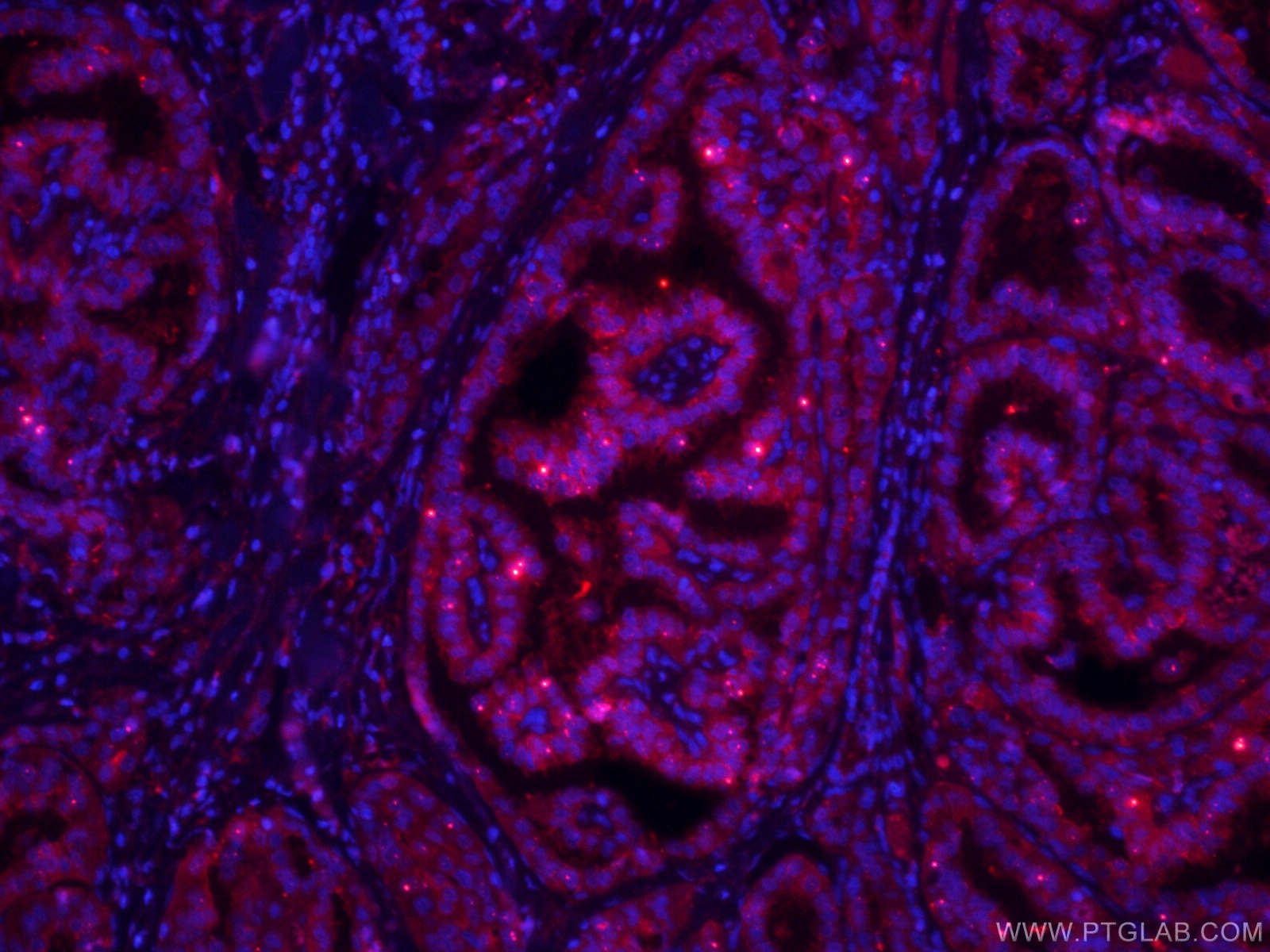 Immunofluorescence (IF) / fluorescent staining of human thyroid cancer tissue using CoraLite®594-conjugated Galectin-3 Monoclonal anti (CL594-60207)