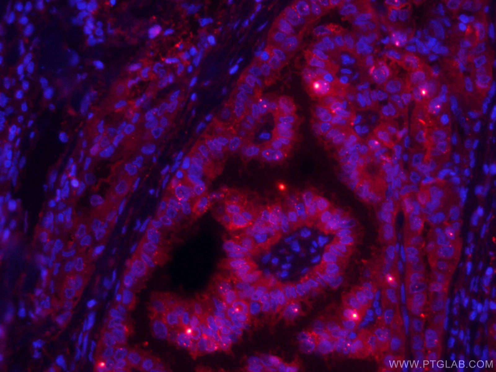 Immunofluorescence (IF) / fluorescent staining of human thyroid cancer tissue using CoraLite®594-conjugated Galectin-3 Monoclonal anti (CL594-60207)
