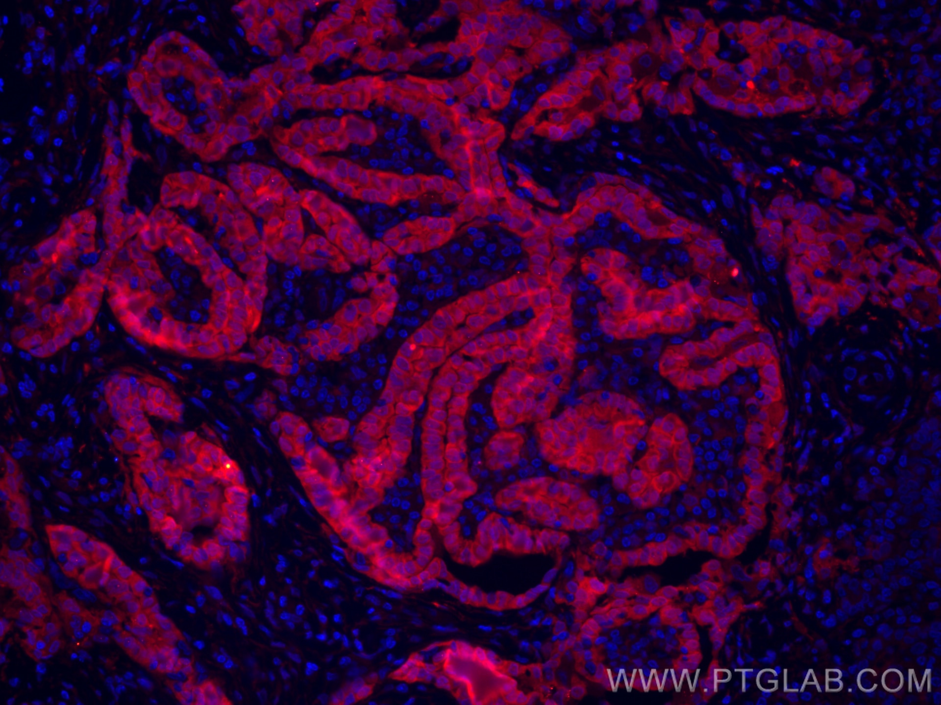 Immunofluorescence (IF) / fluorescent staining of human thyroid cancer tissue using CoraLite®594-conjugated Galectin-3 Monoclonal anti (CL594-60207)