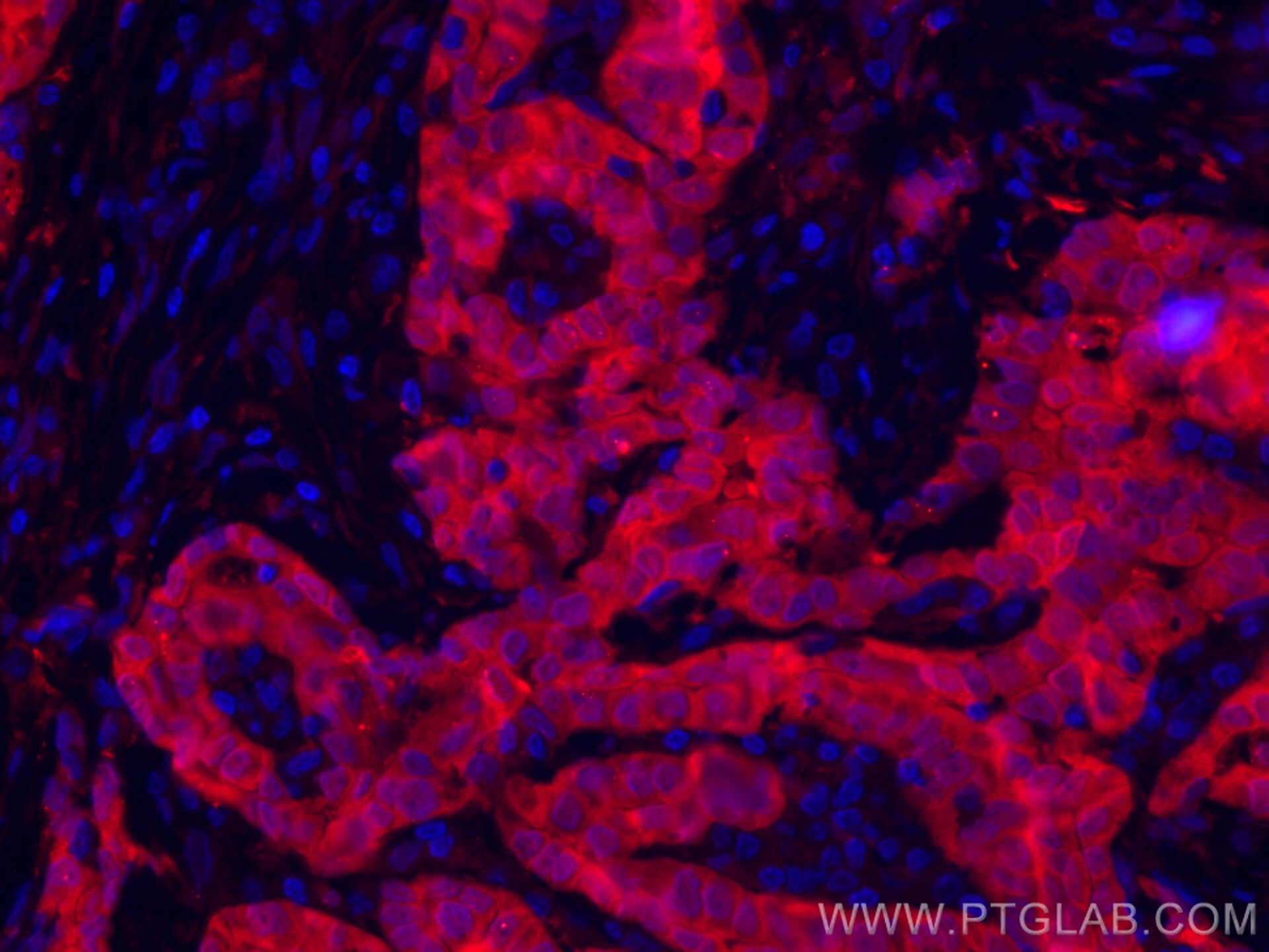 Immunofluorescence (IF) / fluorescent staining of human thyroid cancer tissue using CoraLite®594-conjugated Galectin-3 Monoclonal anti (CL594-60207)