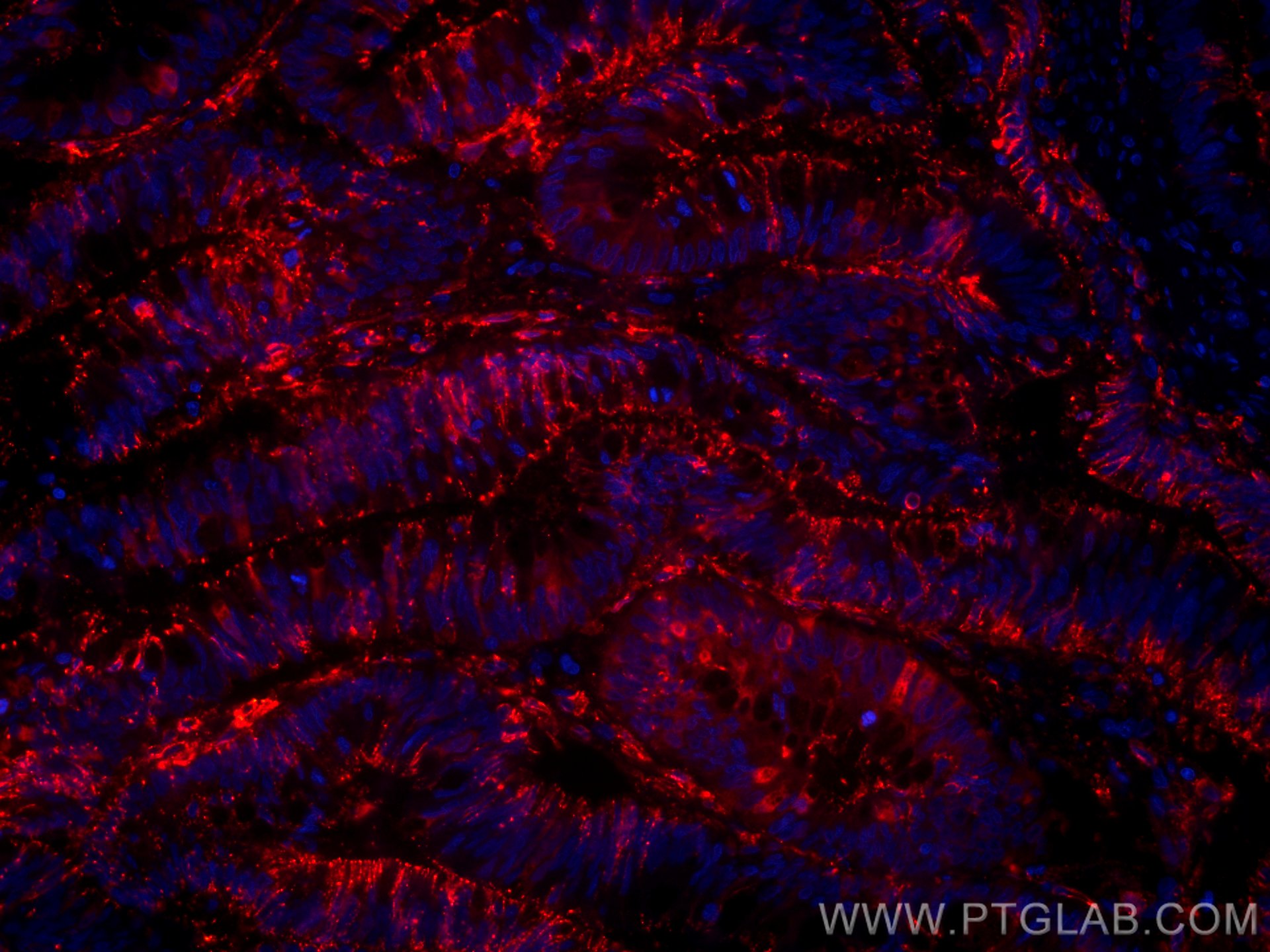 Immunofluorescence (IF) / fluorescent staining of human colon cancer tissue using CoraLite®594-conjugated Galectin-4 Monoclonal anti (CL594-66686)