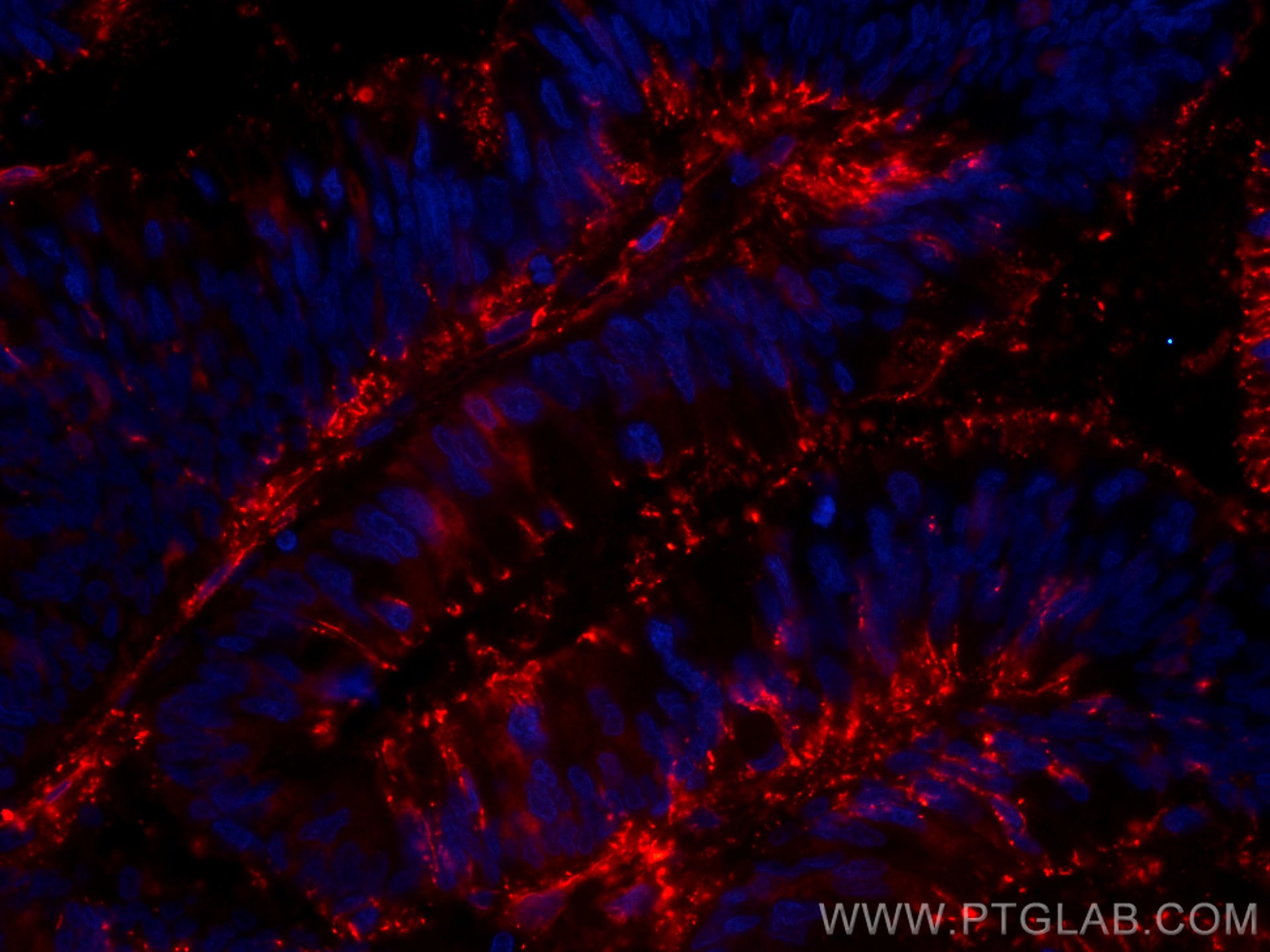 Immunofluorescence (IF) / fluorescent staining of human colon cancer tissue using CoraLite®594-conjugated Galectin-4 Monoclonal anti (CL594-66686)