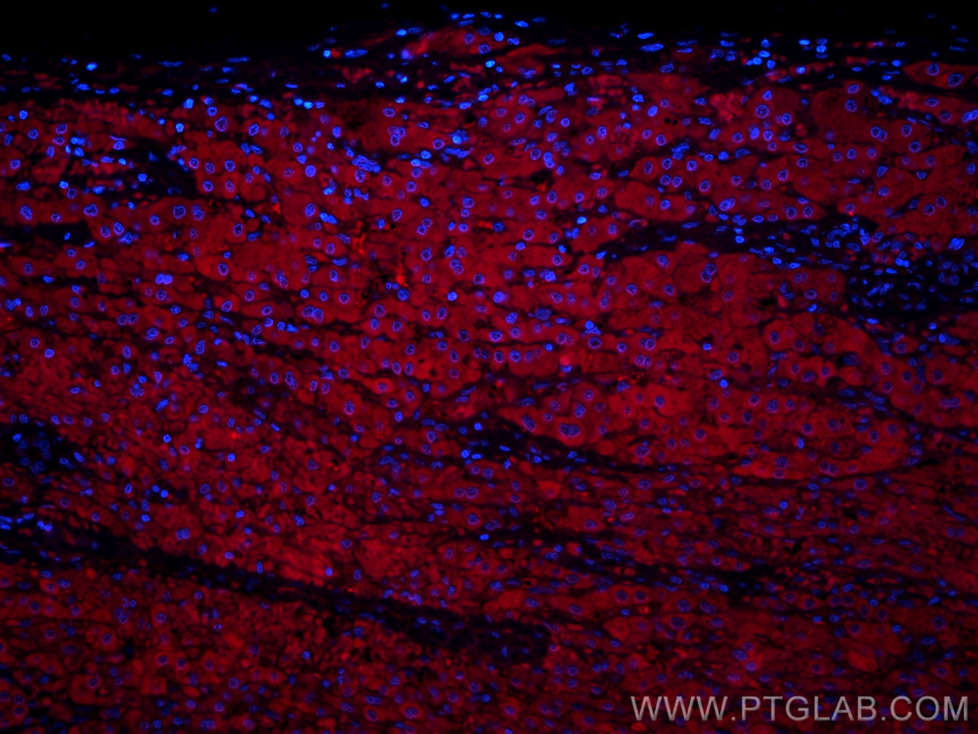 Immunofluorescence (IF) / fluorescent staining of human liver cancer tissue using CoraLite®594-conjugated Gamma Cystathionase Polycl (CL594-12217)