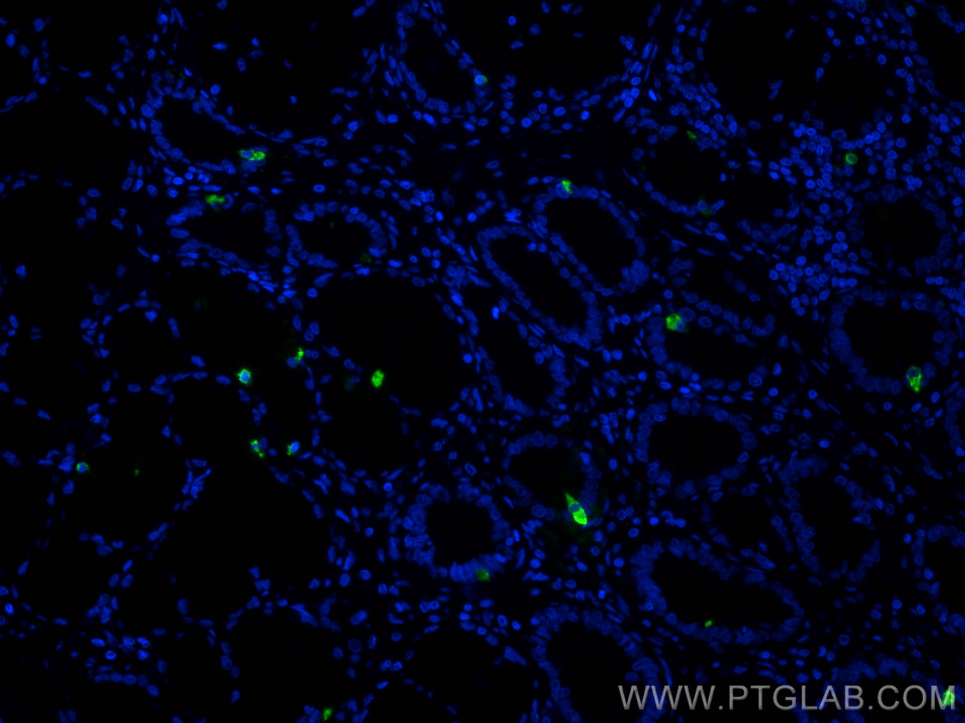 Immunofluorescence (IF) / fluorescent staining of human stomach cancer tissue using Gastrin Monoclonal antibody (60346-1-Ig)