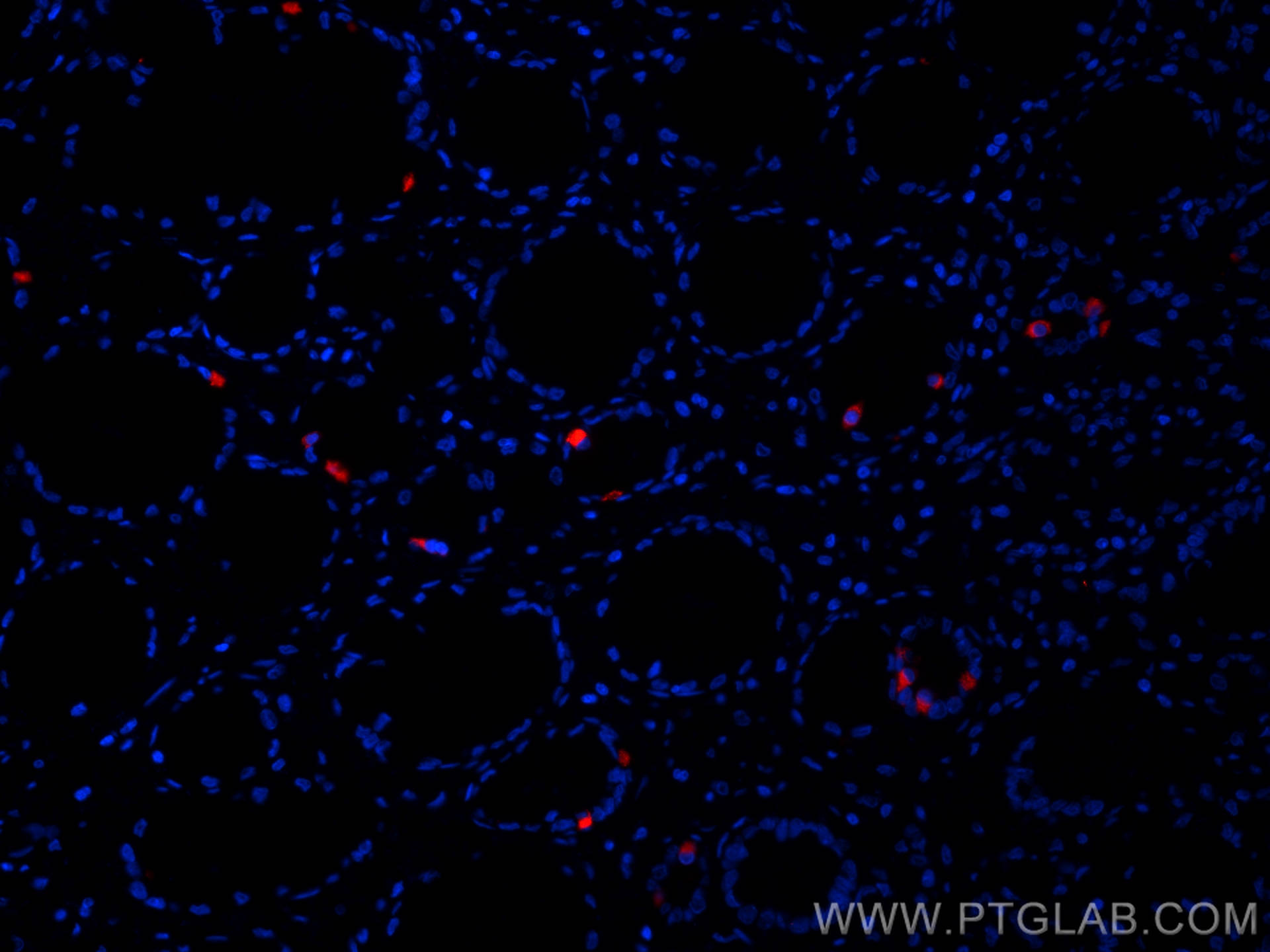 Immunofluorescence (IF) / fluorescent staining of human stomach cancer tissue using CoraLite®594-conjugated Gastrin Monoclonal antibod (CL594-60346)