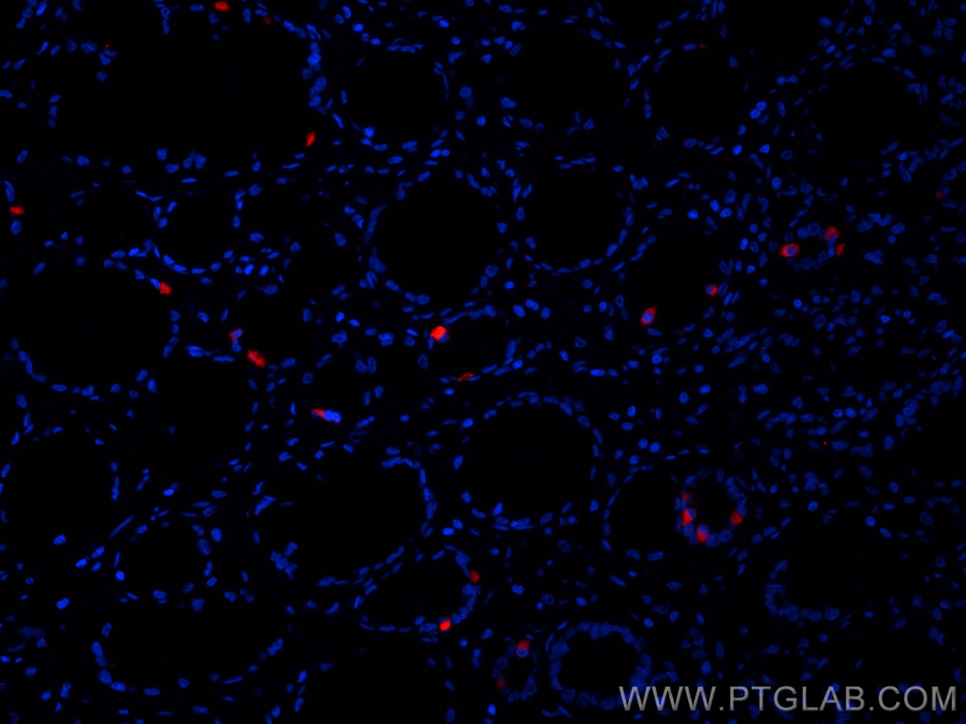 Immunofluorescence (IF) / fluorescent staining of human stomach cancer tissue using CoraLite®594-conjugated Gastrin Monoclonal antibod (CL594-60346)