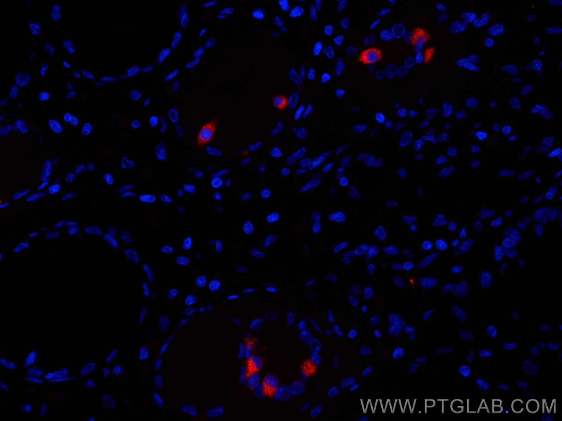 Immunofluorescence (IF) / fluorescent staining of human stomach cancer tissue using CoraLite®594-conjugated Gastrin Monoclonal antibod (CL594-60346)