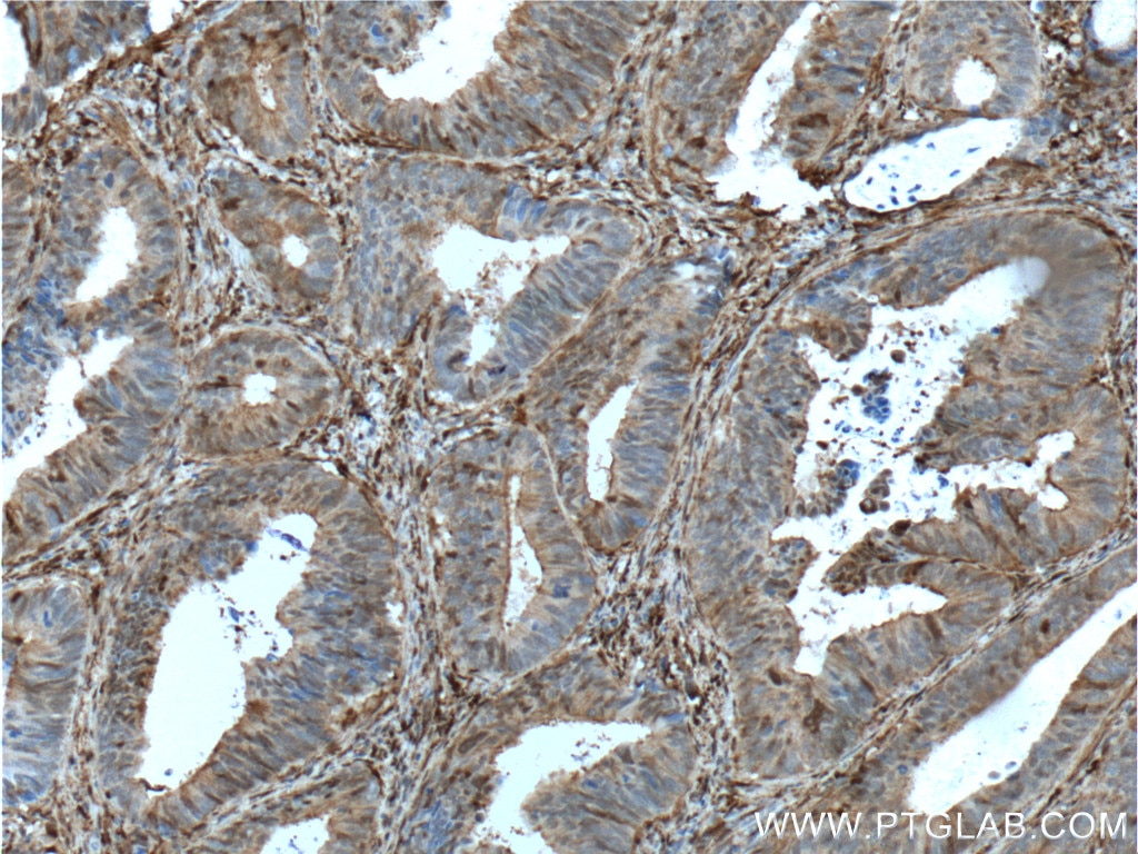 Immunohistochemistry (IHC) staining of human colon cancer tissue using Gelsolin Monoclonal antibody (66280-1-Ig)