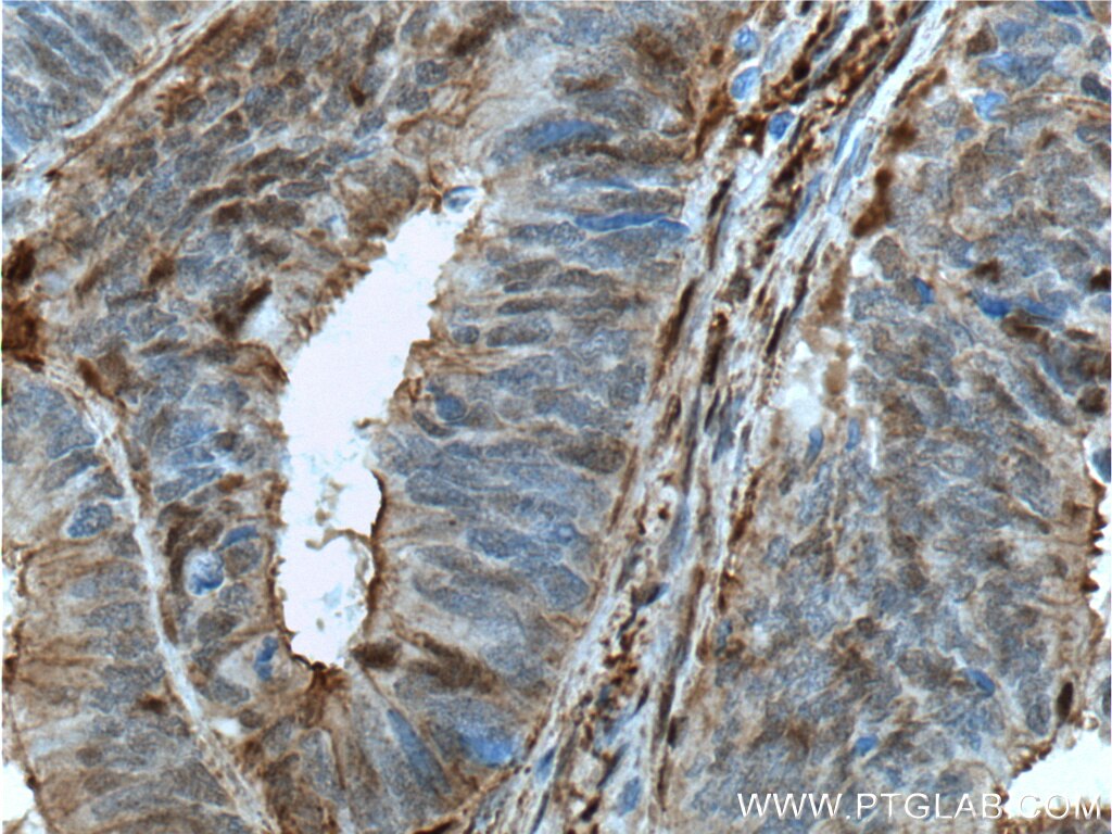 Immunohistochemistry (IHC) staining of human colon cancer tissue using Gelsolin Monoclonal antibody (66280-1-Ig)