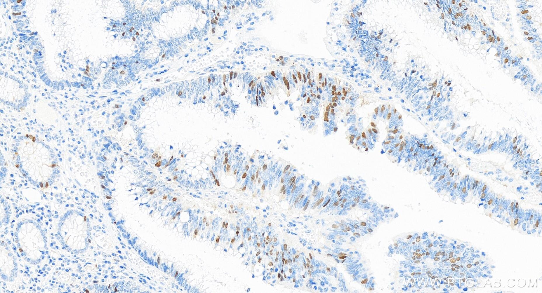 Immunohistochemistry (IHC) staining of human colon cancer tissue using Geminin Recombinant antibody (84199-2-RR)