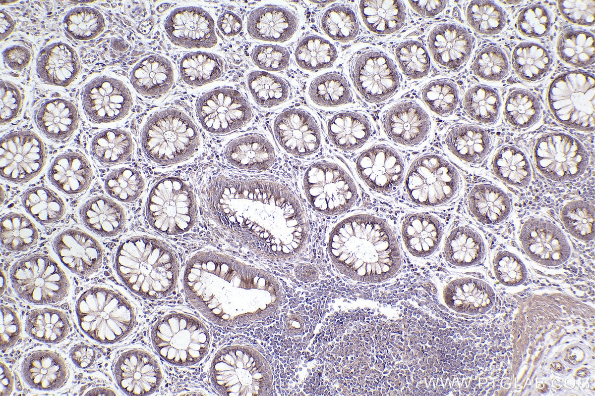 IHC staining of human rectal cancer using 22270-1-AP Immunohistochemistry (IHC) staining of human rectal cancer tissue using Giantin Polyclonal antibody (22270-1-AP)