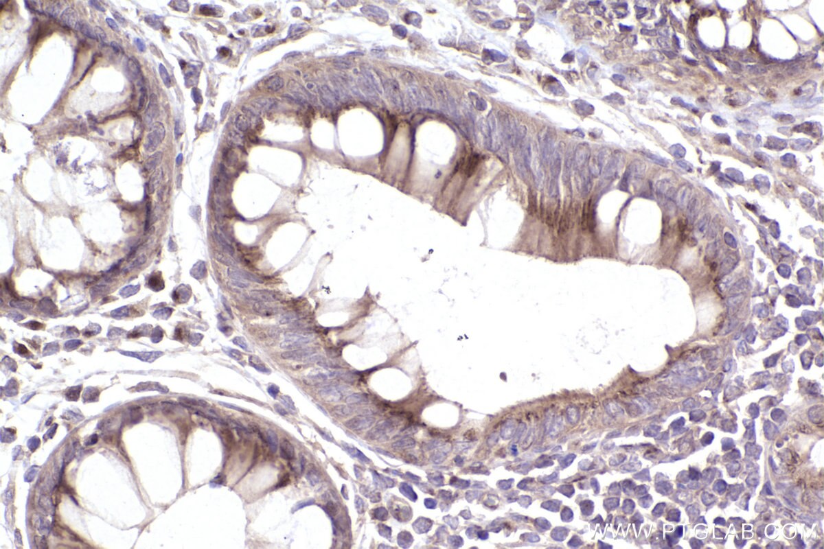 IHC staining of human rectal cancer using 22270-1-AP Immunohistochemistry (IHC) staining of human rectal cancer tissue using Giantin Polyclonal antibody (22270-1-AP)