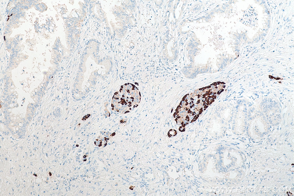 Immunohistochemistry (IHC) staining of human pancreas cancer tissue using Glucagon Monoclonal antibody (67286-1-Ig)