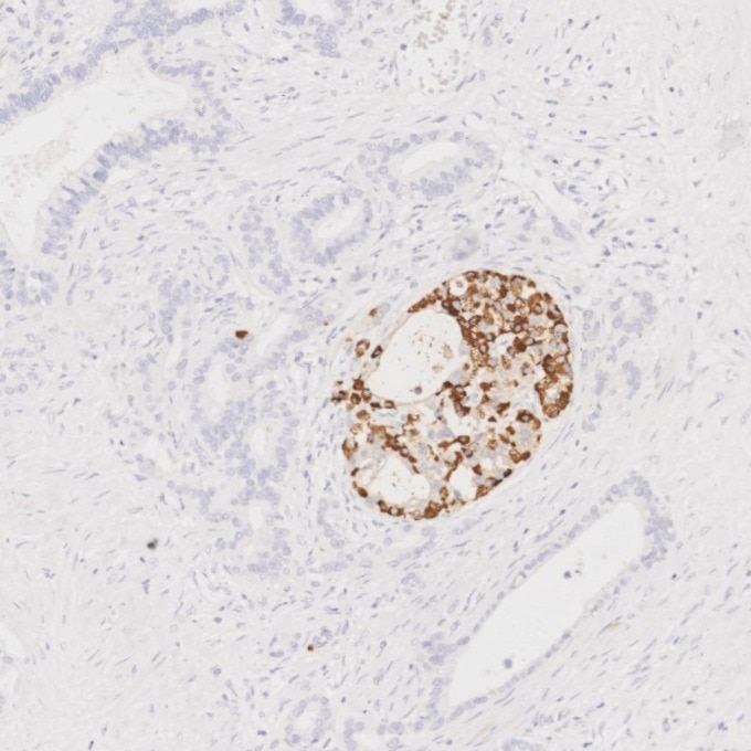IHC staining of human pancreas cancer using 67286-1-Ig Immunohistochemistry (IHC) staining of human pancreas cancer tissue using Glucagon Monoclonal antibody (67286-1-Ig)