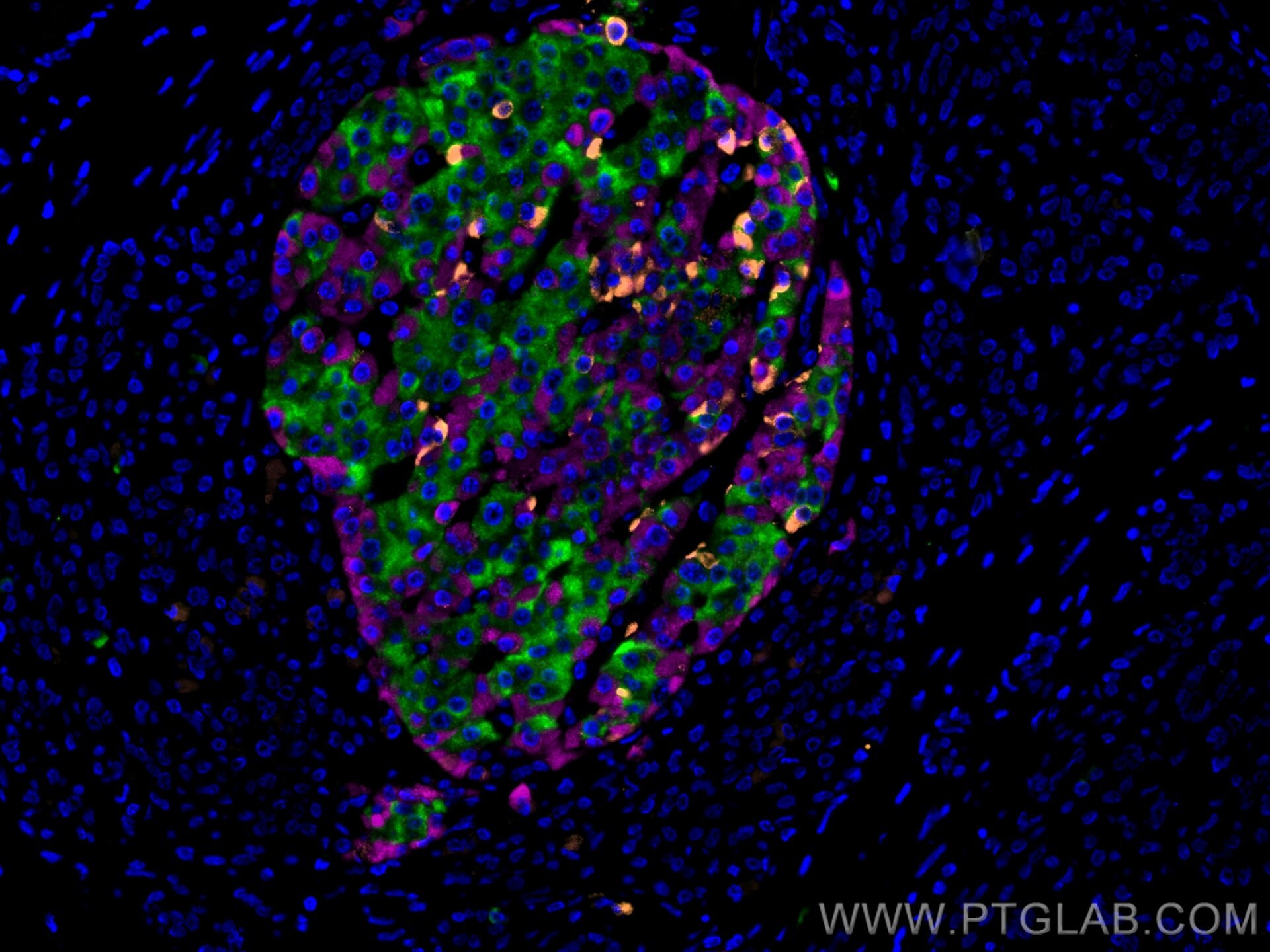 Immunofluorescence (IF) / fluorescent staining of human pancreas cancer tissue using CoraLite® Plus 647-conjugated Glucagon Polyclonal  (CL647-15954)