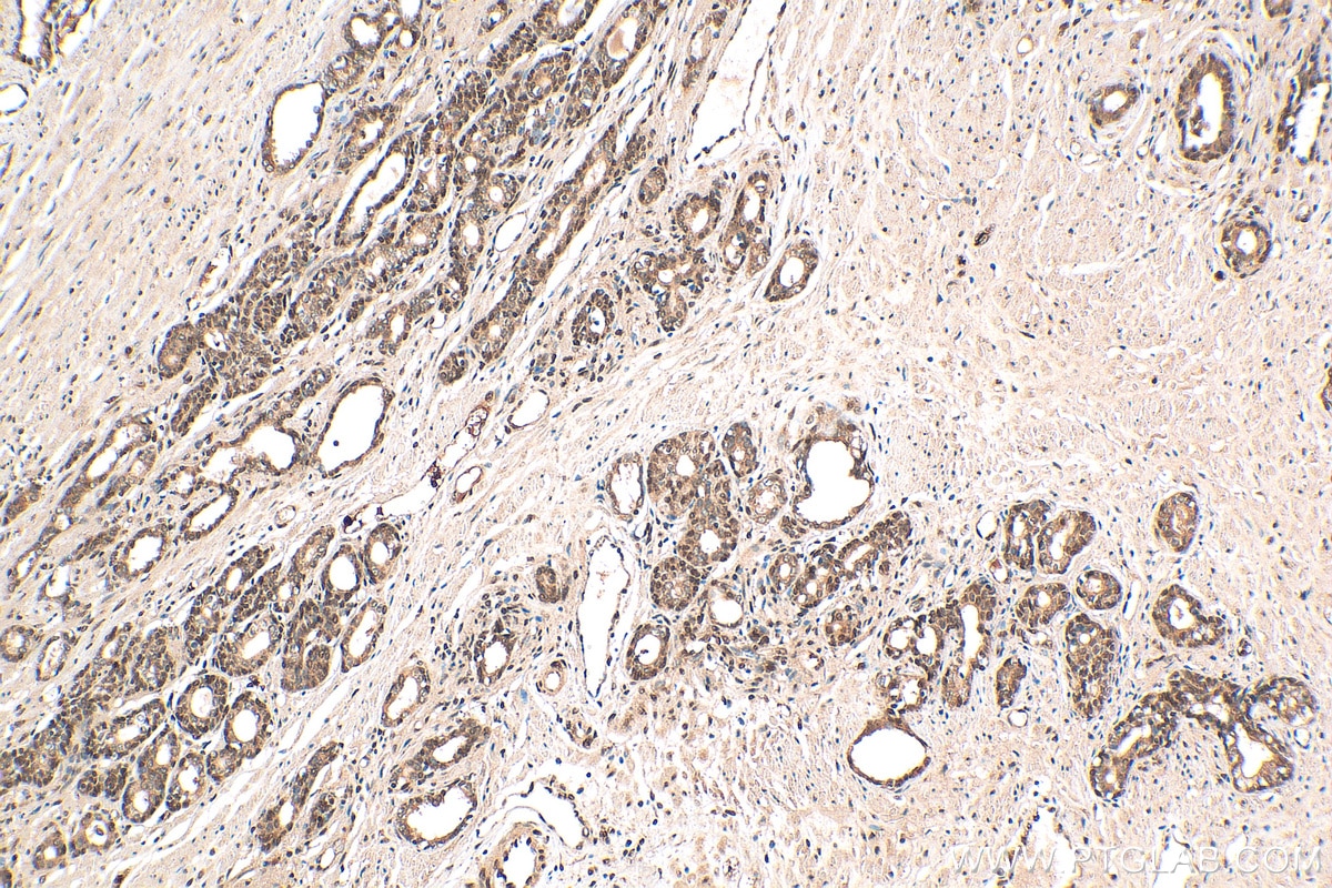 IHC staining of human prostate cancer using 82619-4-RR