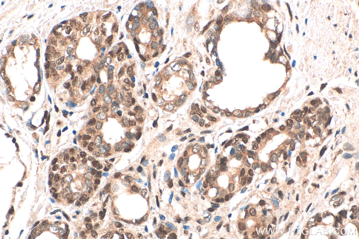 Immunohistochemistry (IHC) staining of human prostate cancer tissue using Glucocorticoid receptor Recombinant antibody (82619-4-RR)