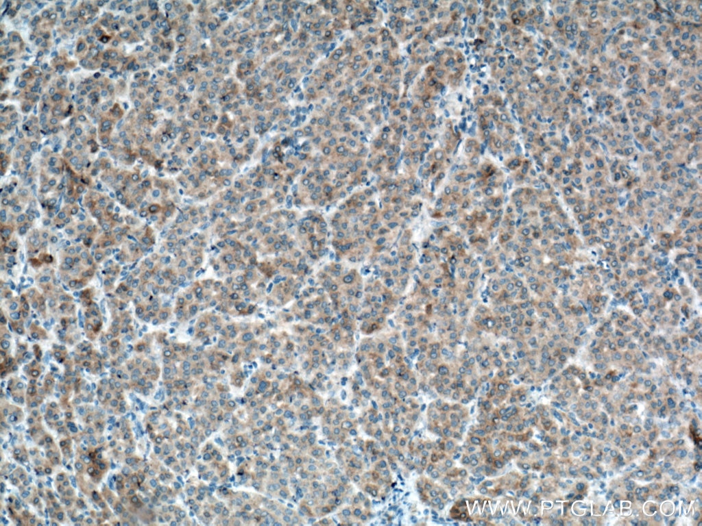 Immunohistochemistry (IHC) staining of human liver cancer tissue using Glutamine Synthetase Monoclonal antibody (66323-1-Ig)