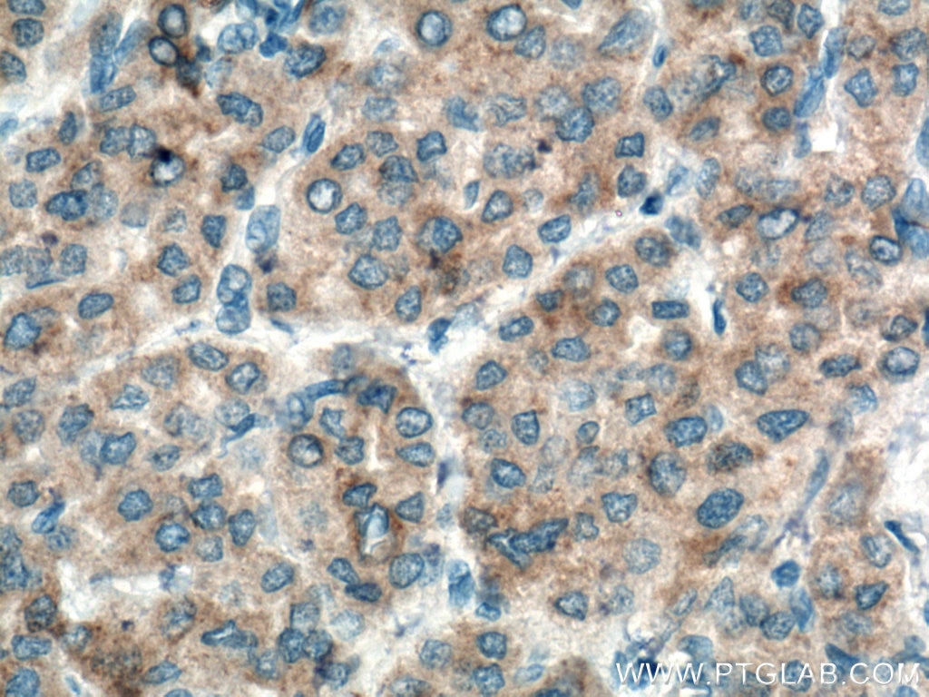 IHC staining of human liver cancer using 66323-1-Ig