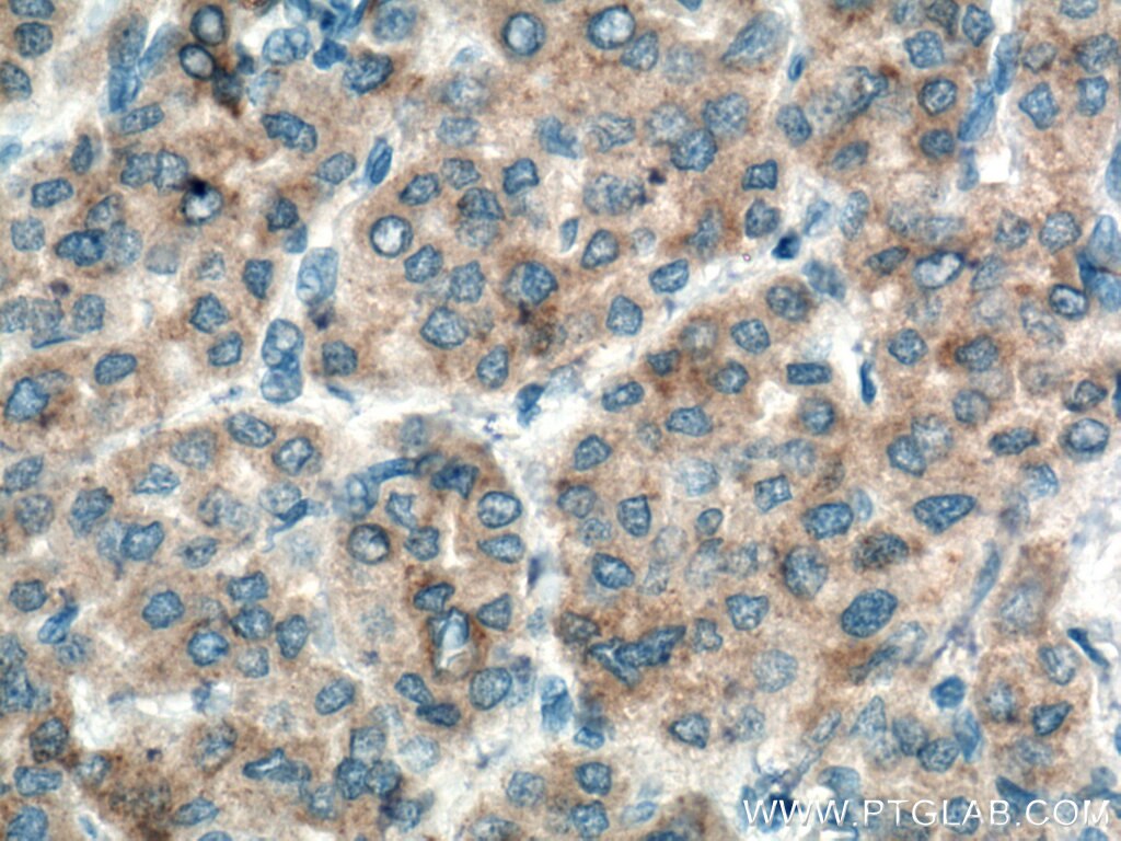 Immunohistochemistry (IHC) staining of human liver cancer tissue using Glutamine Synthetase Monoclonal antibody (66323-1-Ig)